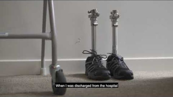 Picture of persons prosthetic legs with shoes on